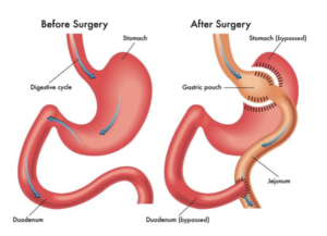 Roux-en-Y Gastric Bypass (RYGB) surgery - The Endocrine Doc