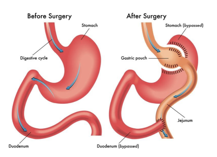 Roux en Y Gastric Bypass RYGB Surgery The Endocrine Doc